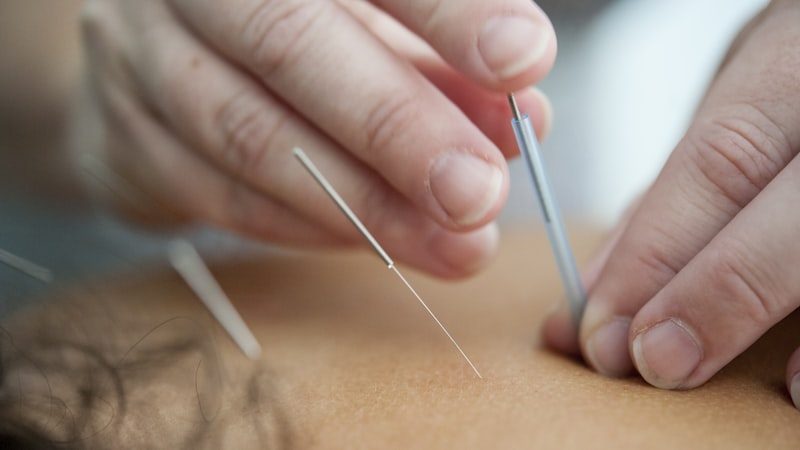 Acupuncture needle therapy session